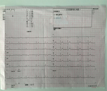 心电图大图.jpg